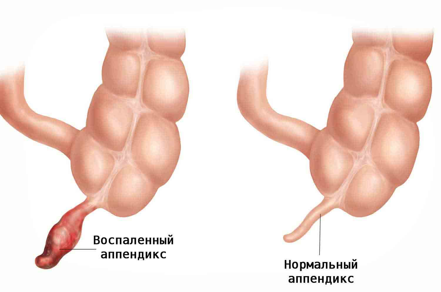 vospalennyy-appendiks-4