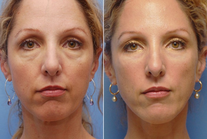 juvederm