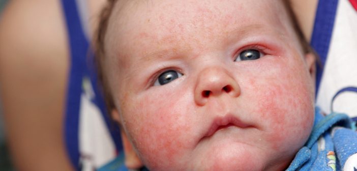 Newborn has eczema