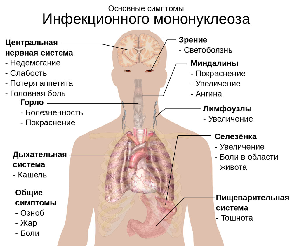 Main_symptoms_of_Infectious_mononucleosis_RU
