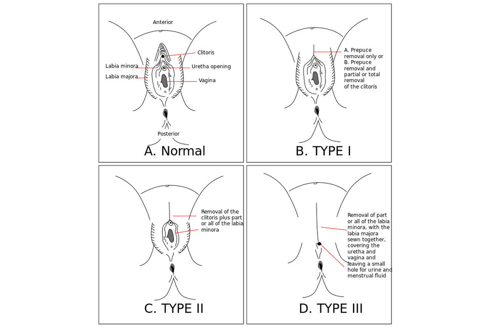 Обрезание у женщин схема что это такое и зачем