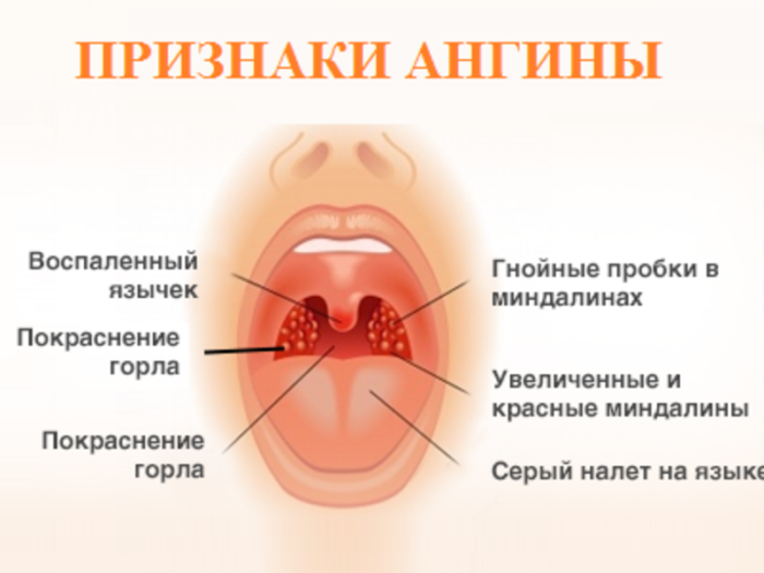doktor-komarovskij-ob-angine-4