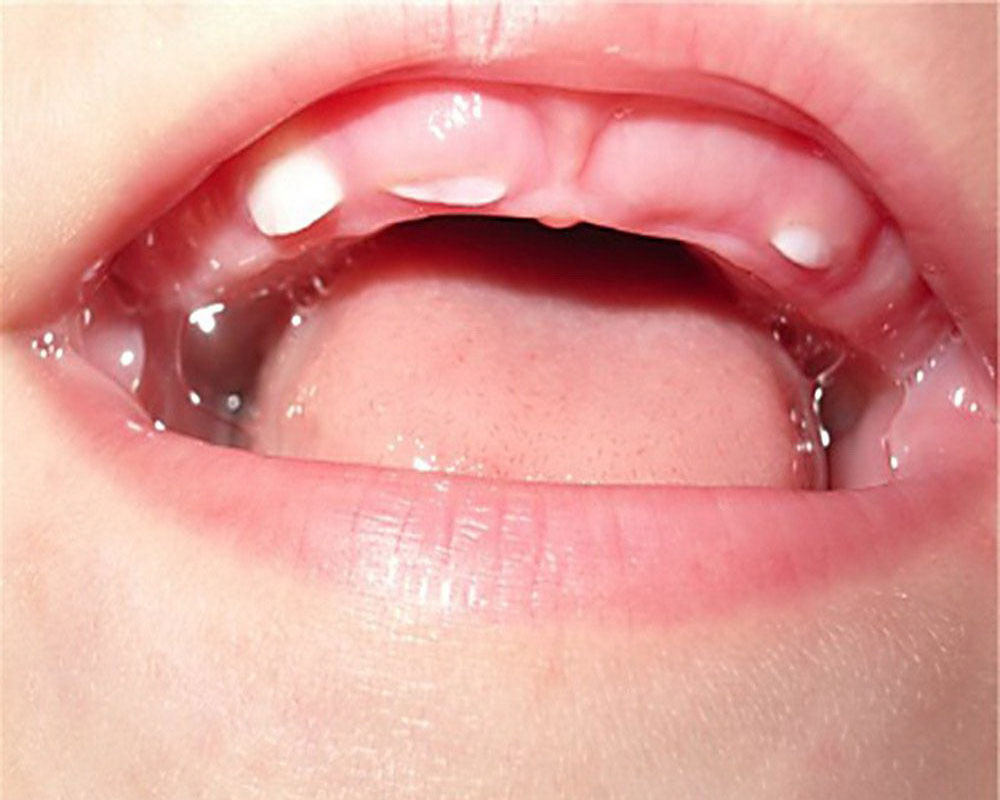 narushenie-razvitiya-i-prorezyvaniya-zubov2