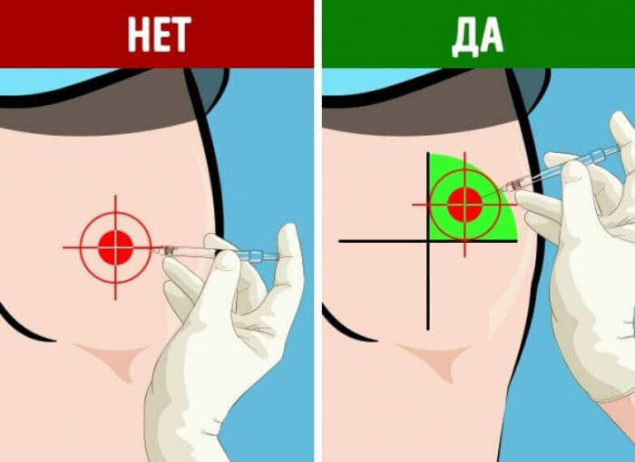 abscess-yagodicy-simptomy-i-lechenie-6