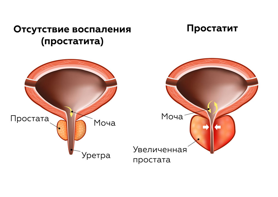 massazh-prostaty (1)